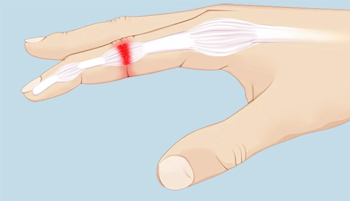 Finger Sprain - Cause, Symptoms, Treatment - Samarpan Physio