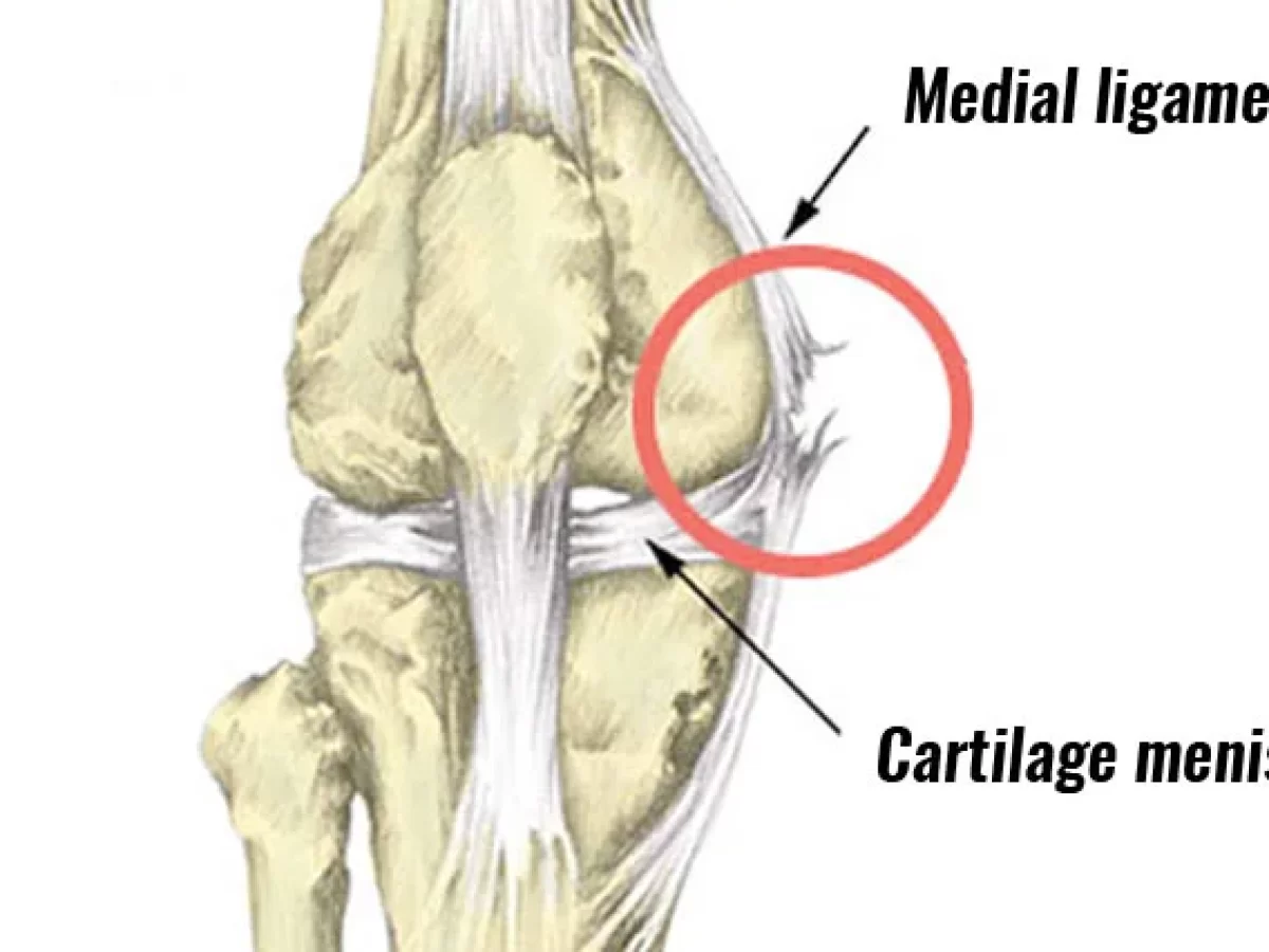 Medial Collateral Ligament (MCL) Tear Surrey and New Westminster BC : Prana  Physio
