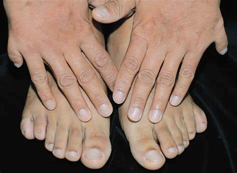 Polydactyly: Symptoms, causes, and treatments