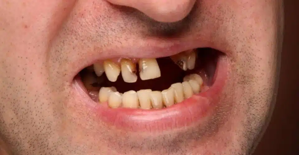 Loose teeth