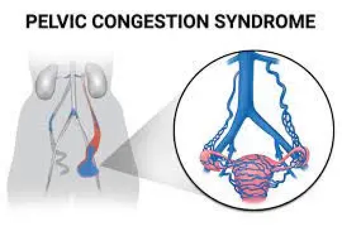 Pelvic Congestion Syndrome - Physiopedia