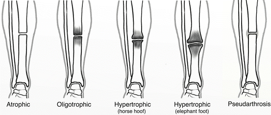 non-union-bone-fracture-type-cause-symptoms-treatment