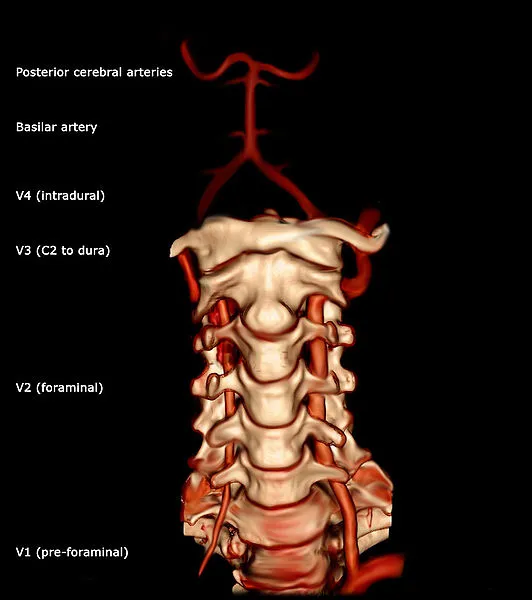 vertebral artery test sitting