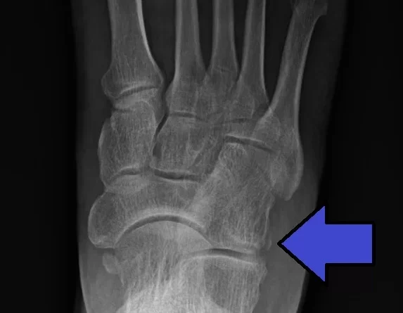 cuboid-fracture-recovery-archives-samarpan-physiotherapy-clinic-ahmedabad