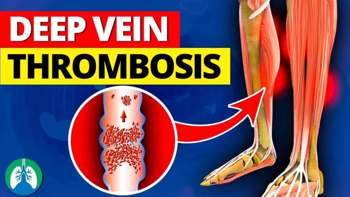 What is Deep Vein Thrombosis, and What Are the Treatments?