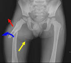 Anatomical Snuffbox - Anatomt, Border, Structure, Function