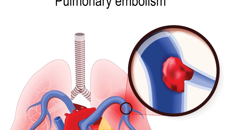 pulmonary-embolism-chest-pain-location-archives-samarpan