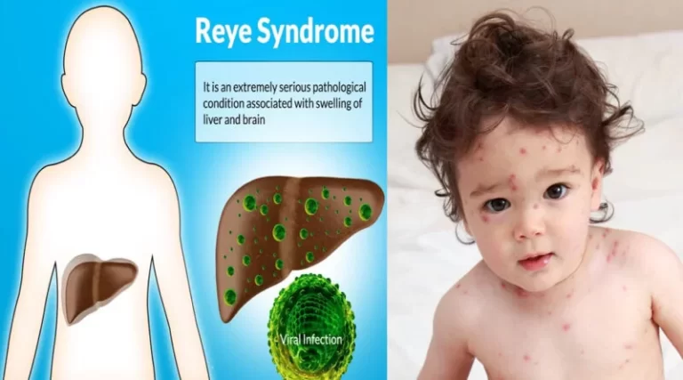 Reye’s Syndrome