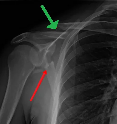 Scapula Fracture (shoulder Blade Fracture) - Samarpan Physiotherapy Clinic