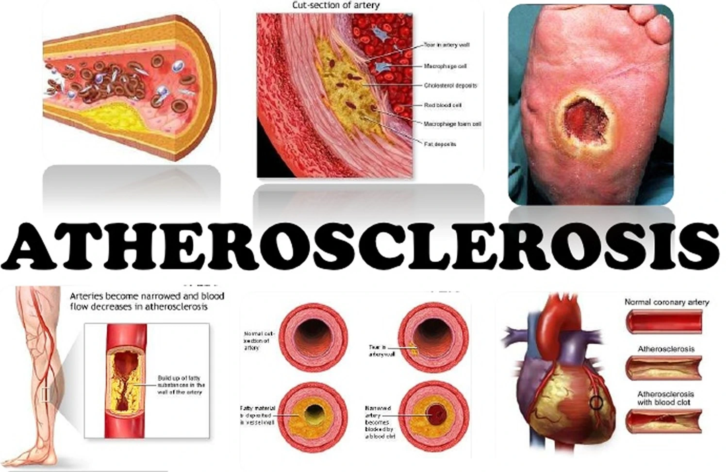 Atherosclerosis - Cause, Symptoms, Treatment - Samarpan Physio