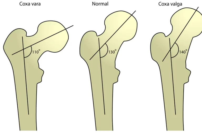 coxa valga