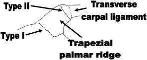 Trapezium Fracture Classification
