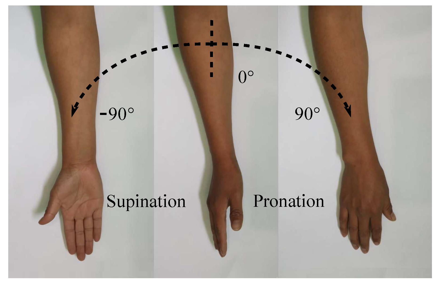 Wrist Orthopaedic Test: Supination Lift Test