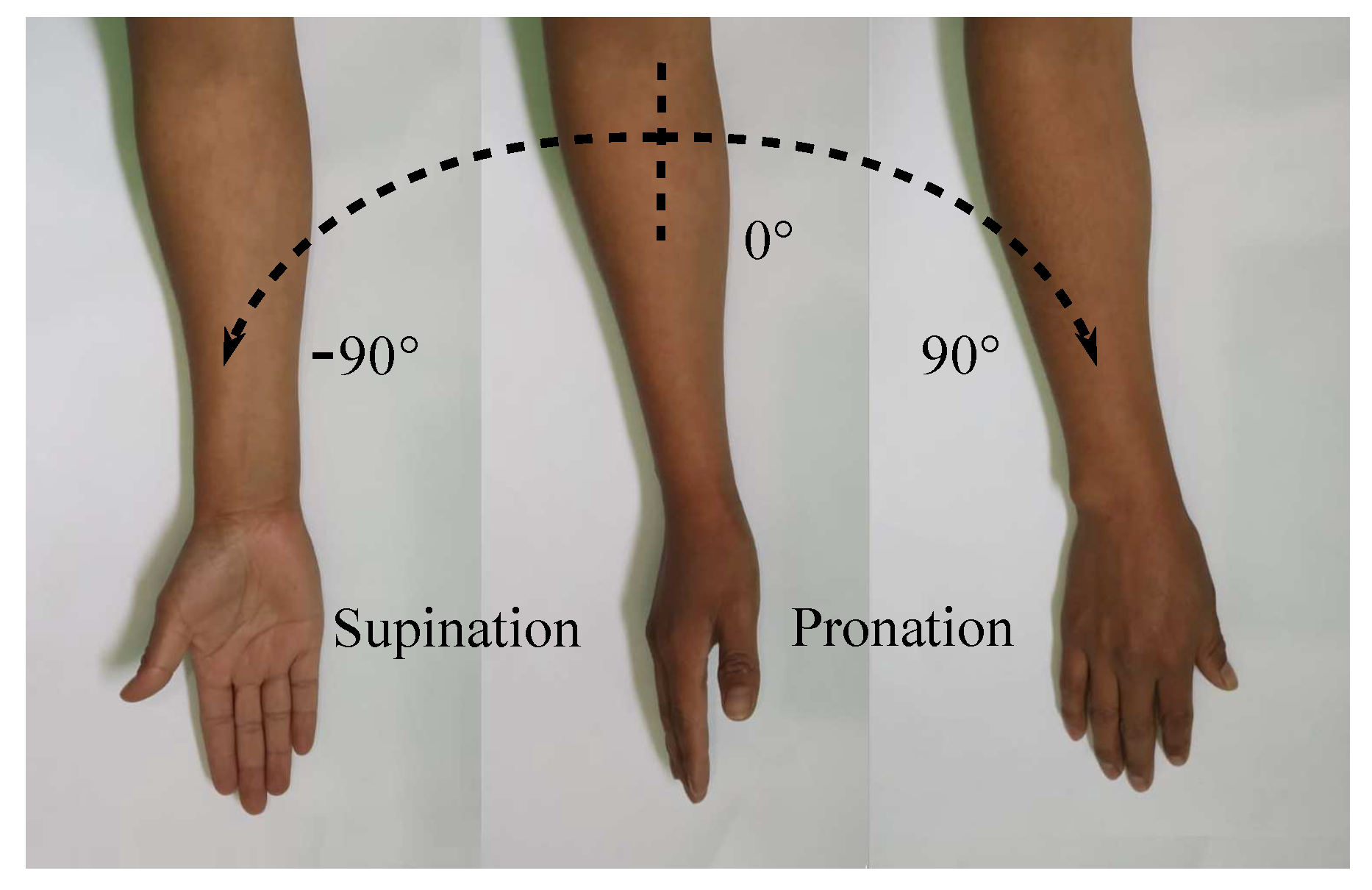 Supination Pronation Test  Distal Biceps Tendon Rupture