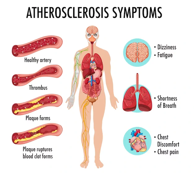 symptoms of atherosclerosis