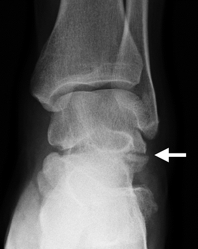 talus fracture