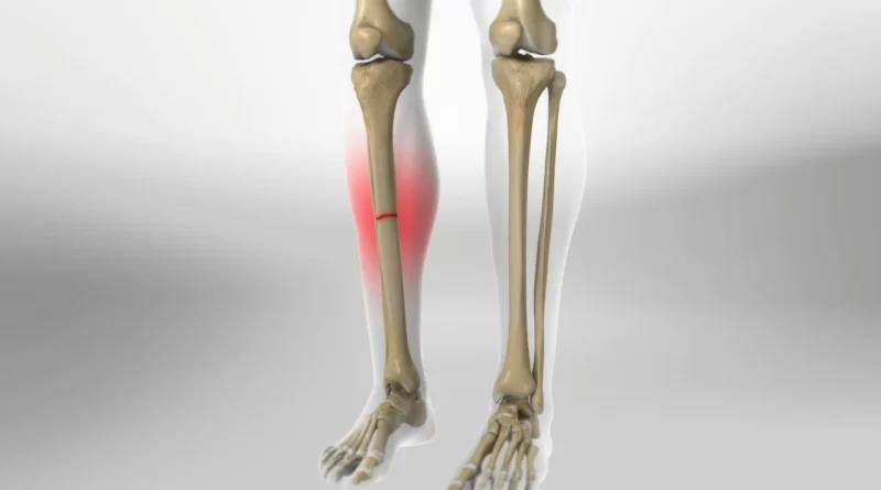 tibia-fracture-type-cause-symptoms-treatment-samarpan