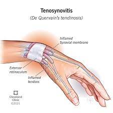 Flexor Pollicis Longus Tenosynovitis