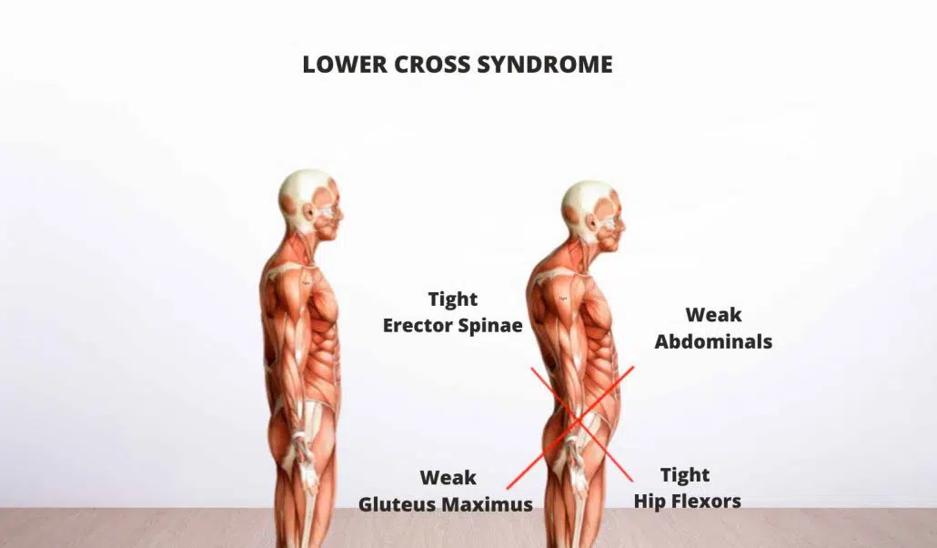 Lower cross syndrome
