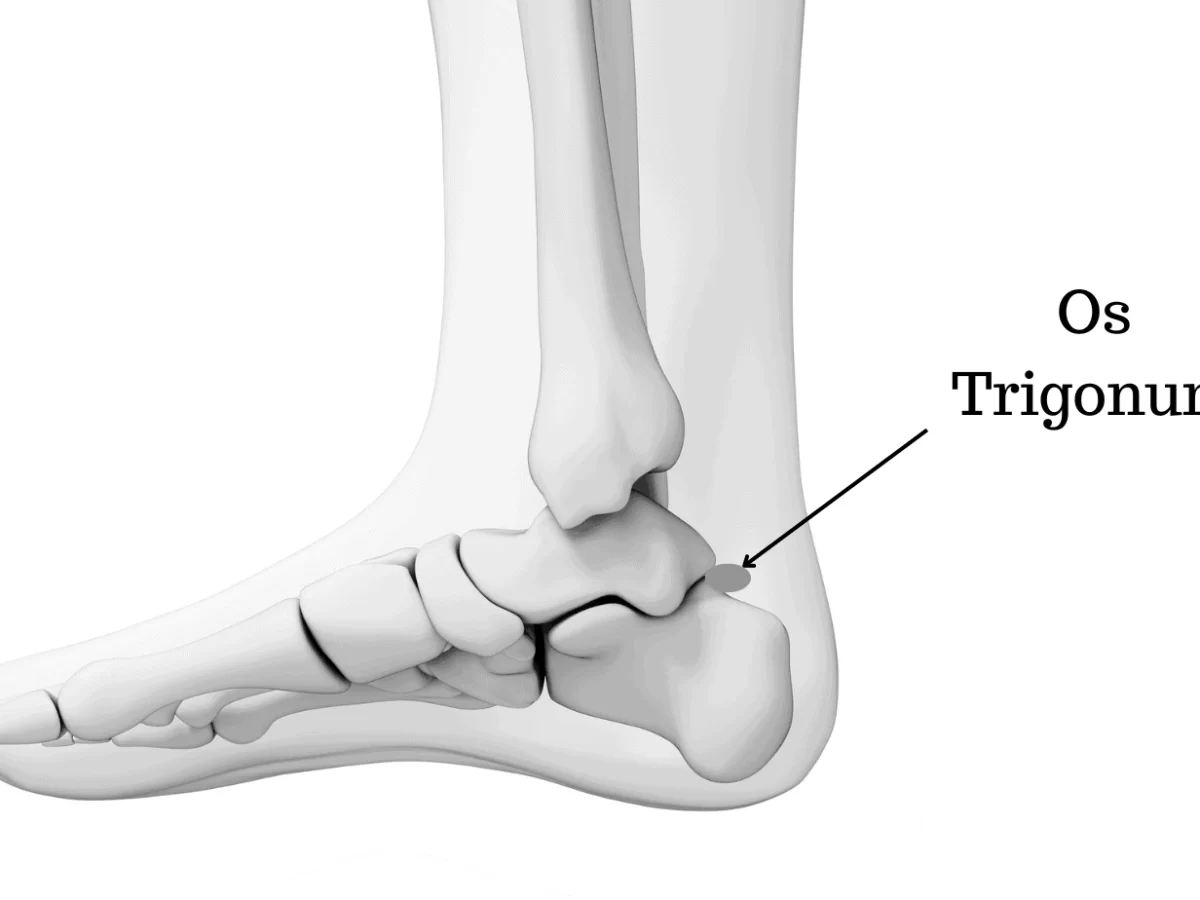 Extra heel clearance bone