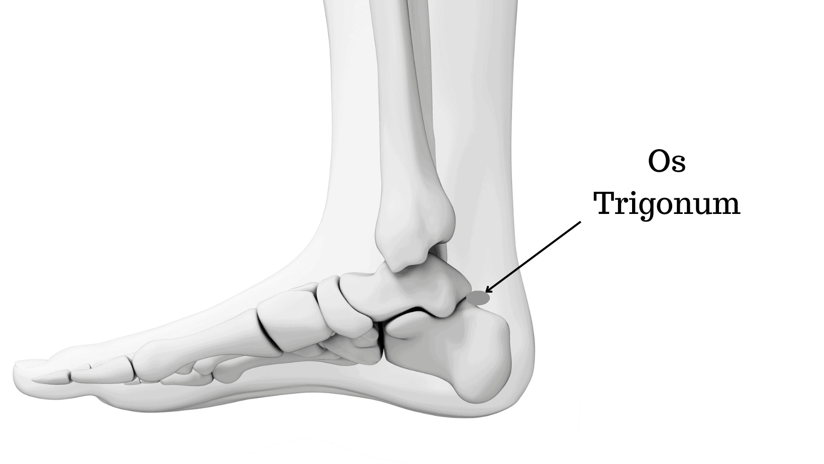 Os trigonum Syndrome - Cause, Symptoms, Treatment - Samarpan