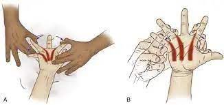 Palmar interossei muscle stretching