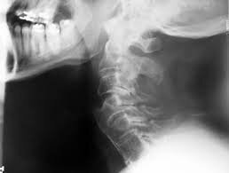 cervical spine fracture