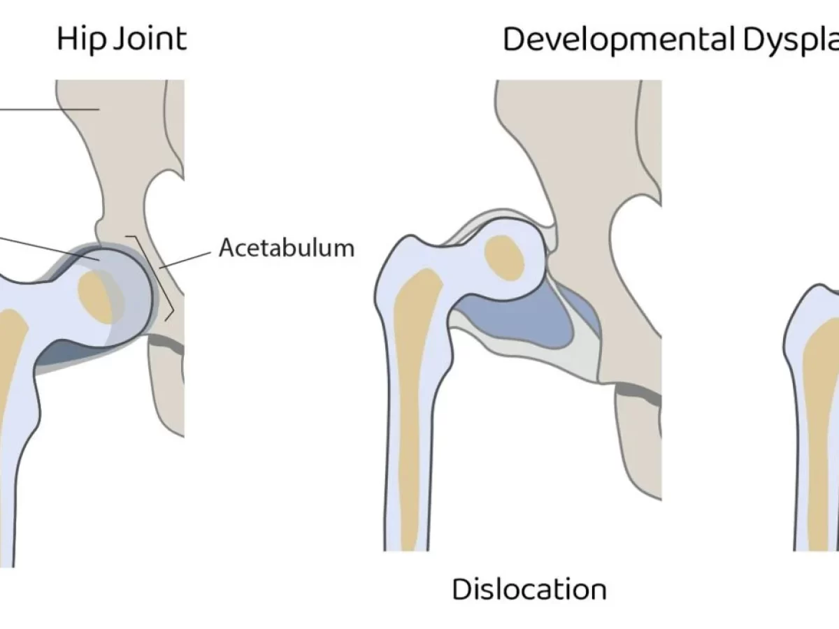 Atlanto-axial Subluxation Radiology Reference Article, 43% OFF