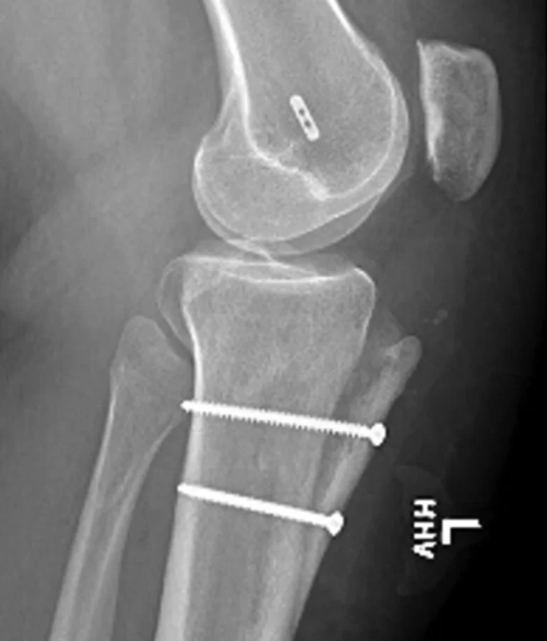 tibial-tubercle-osteotomy