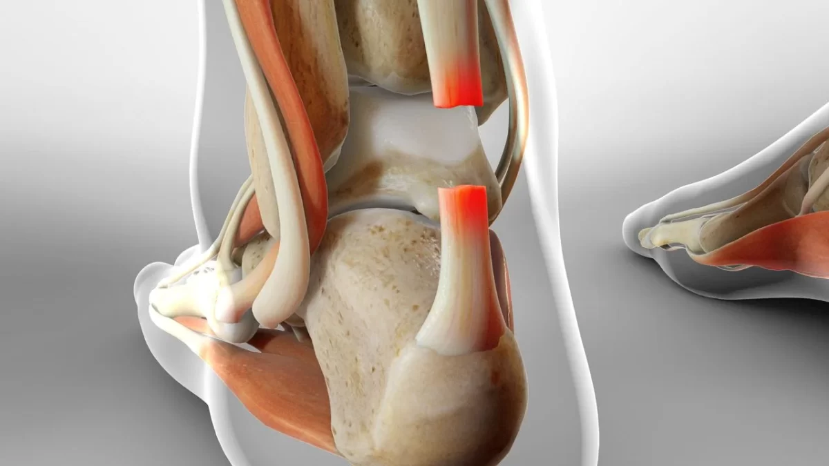 Costoclavicular Syndrome - Symptoms, Treatment - Samarpan