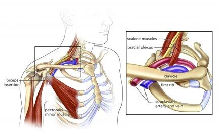 Costoclavicular-syndrome
