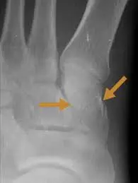 Cuneiform fractures