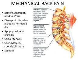 Mechanical Back Pain
