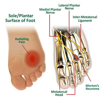 Mortons-neuroma