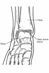 Talar Dome Lesions