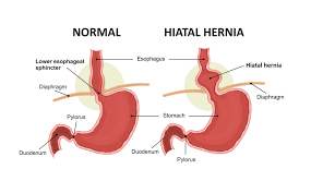 hiatal-hernia