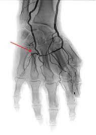 Hypothenar Hammer Syndrome - Cause, Symptoms, Treatment