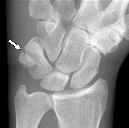 Pisiform Fracture