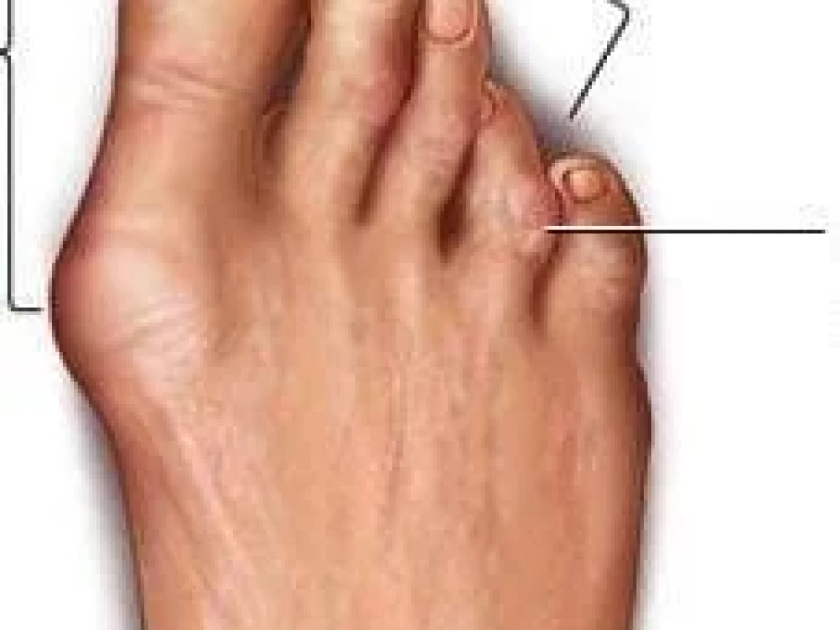 Claw toe : exercises and prevention of deformity
