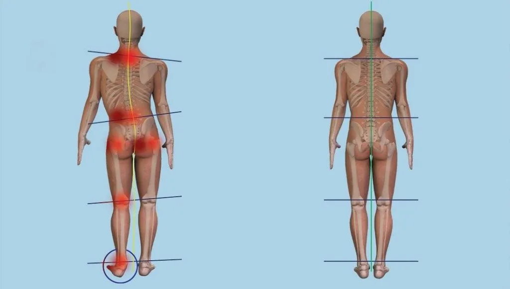Leg-Length-Discrepancy affecting the alignment of body