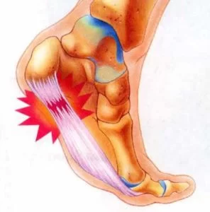 SIGN-SYMPOMS-OF-PLANTAR-FASCIITIS-