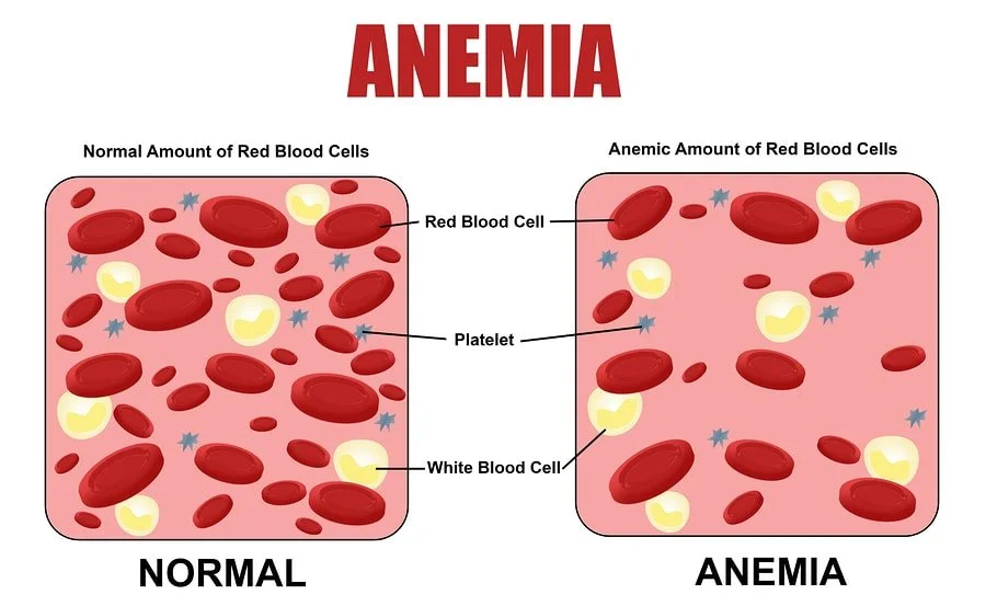 Iron deficiency anaemia: Symptoms and causes