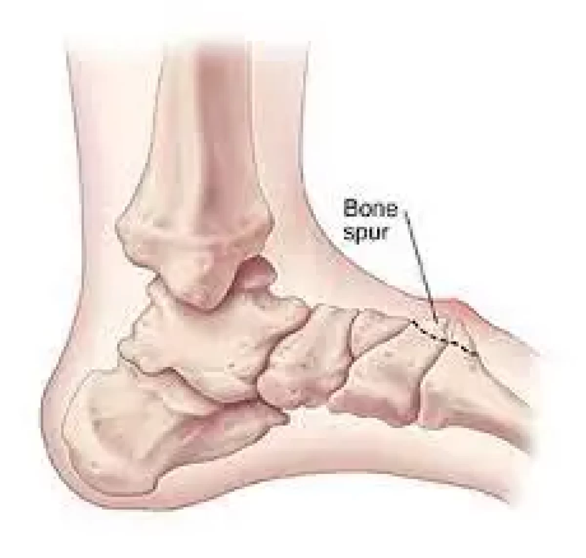 My FootDr - Ever noticed a small, pointed outgrowth under your heel causing  discomfort? That could be a heel spur! Whether it's painless or causing  discomfort, it's often linked with plantar fasciitis.