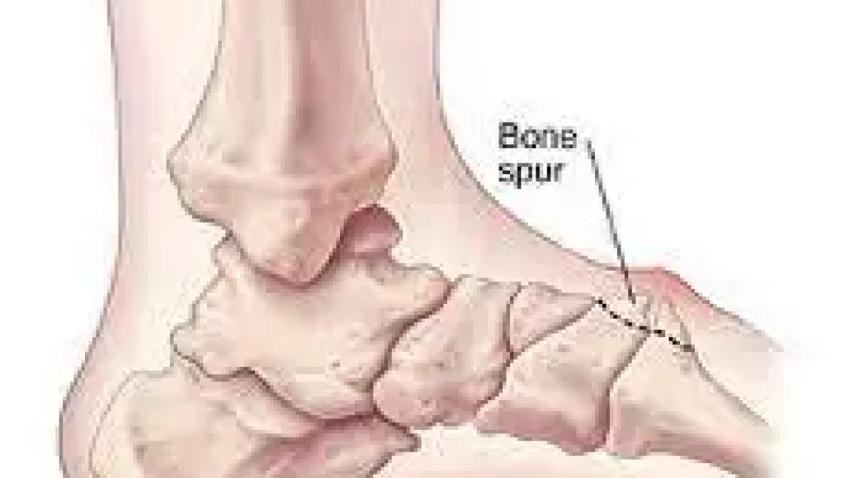 Bone spur in on sale arch of foot