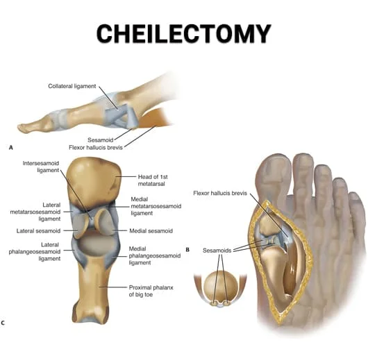 cheilectomy