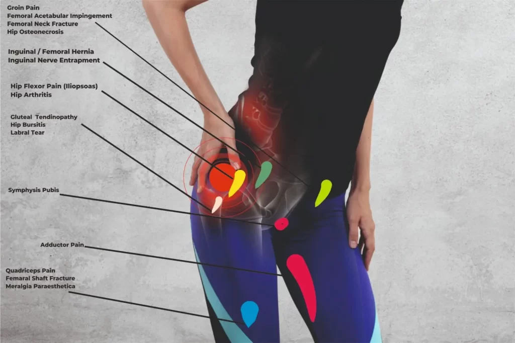 hip-pain-location-diagram-anterior-view
