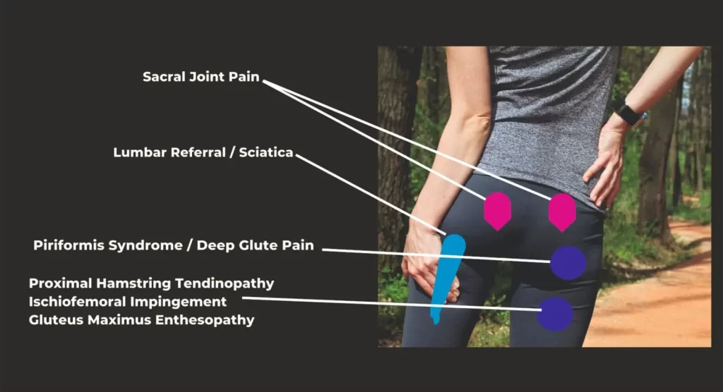 hip-pain-location-diagram-posterior-view