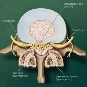 Ligamentum flavum hypertrophy