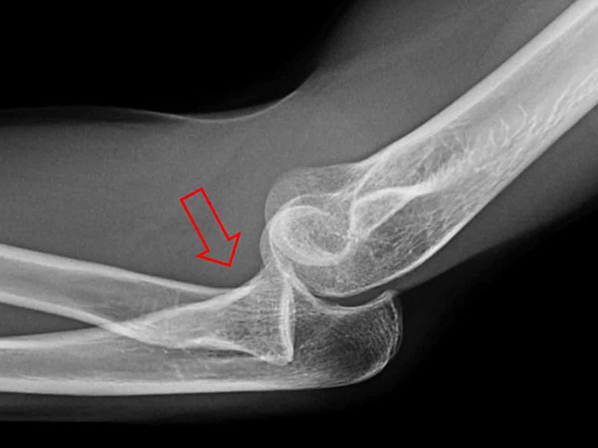 Dislocation risk and 90 degree rule