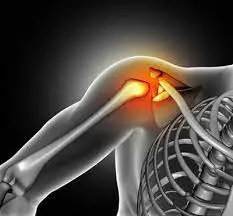 Shoulder Sprain - Cause, Symptoms, Treatment